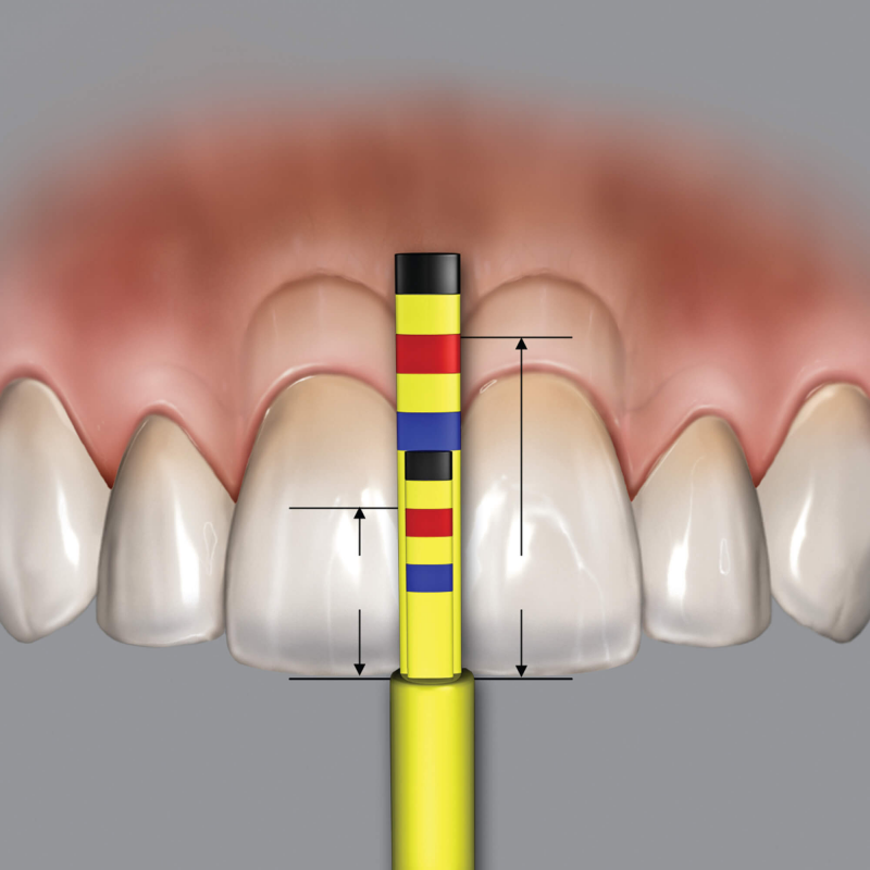 Chu Gauges PAPILLA Ersatztips 3St./Pkg. PAPREF